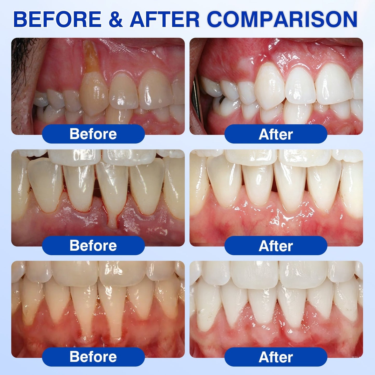 🇦🇺👨‍⚕️✅️💉Evolvion® GumRevive Periodontal Repair Gel