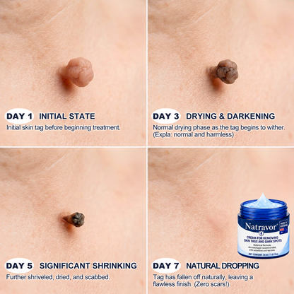 Natravor® 7-𝐃𝐚𝐲 𝐒𝐤𝐢𝐧 𝐓𝐚𝐠 & 𝐒𝐩𝐨𝐭 𝐄𝐫𝐚𝐬𝐞𝐫 𝐂𝐫𝐞𝐚𝐦 (Zero Pain, Zero 𝐒𝐜𝐚𝐫𝐬 Formula) 💎