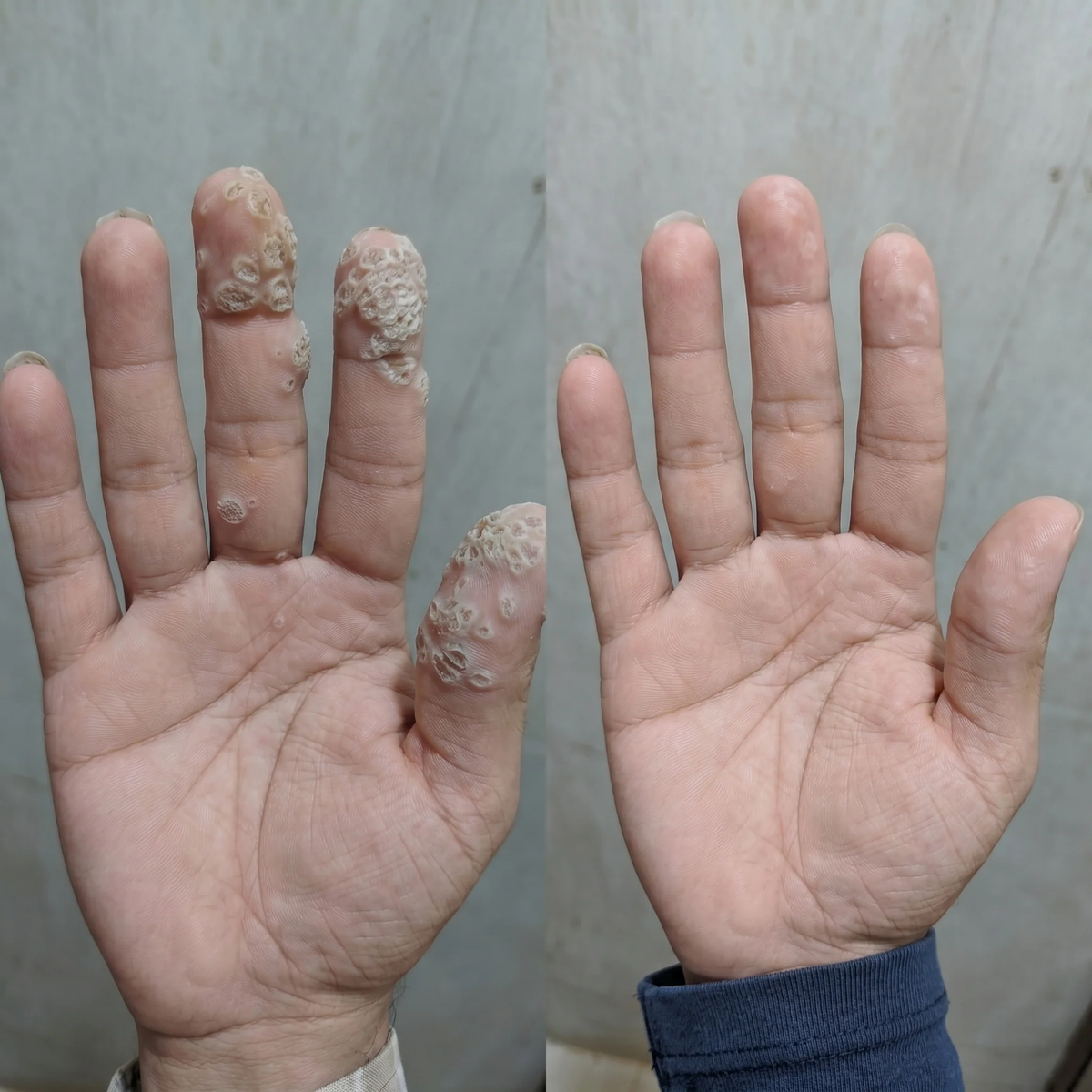 Natravor® 7-𝐃𝐚𝐲 𝐒𝐤𝐢𝐧 𝐓𝐚𝐠 & 𝐒𝐩𝐨𝐭 𝐄𝐫𝐚𝐬𝐞𝐫 𝐂𝐫𝐞𝐚𝐦 (Zero Pain, Zero 𝐒𝐜𝐚𝐫𝐬 Formula) 💎