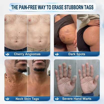 Natravor®💎 7-Day Skin Tag & Spot Eraser (Pain-Free, No-Scars Rollerball)
