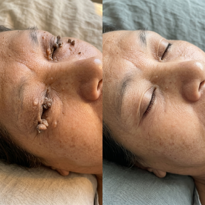 Natravor®💎 7-Day Skin Tag & Spot Eraser (Pain-Free, No-Scars Rollerball)