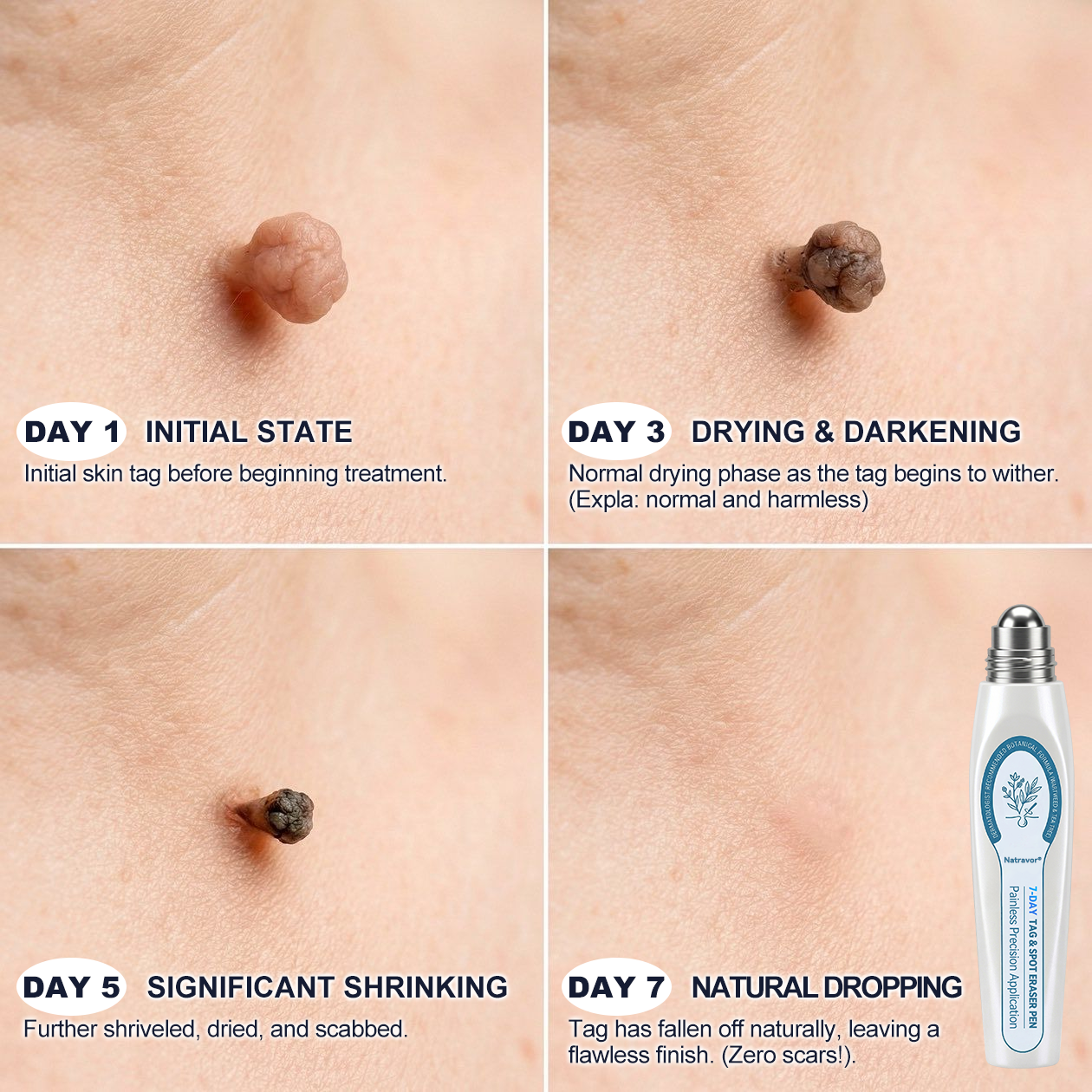 👩‍⚕️Natravor® 7-Day Skin Care Roller Pen 🎆 | Easy At-Home Solution for Skin Imperfections