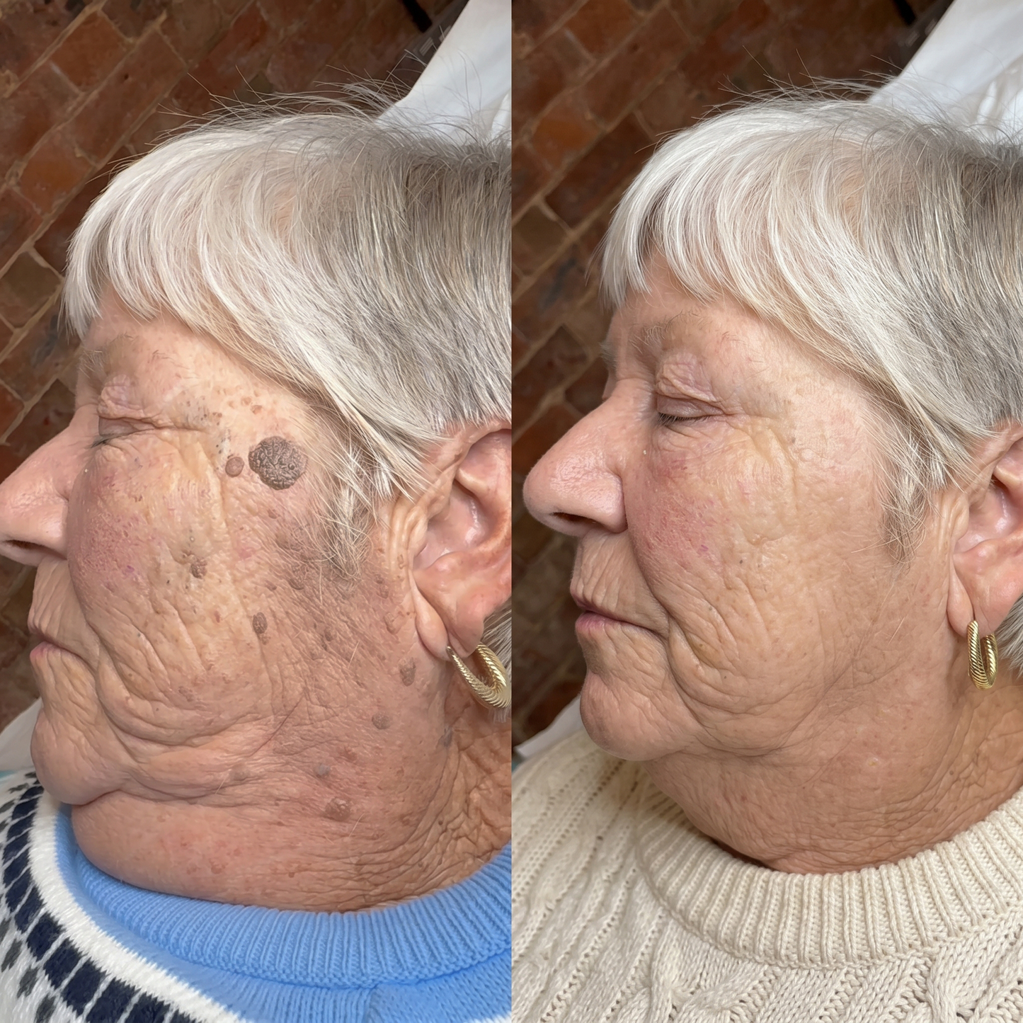 Natravor®💎 7-Day Skin Tag & Spot Eraser (Pain-Free, No-Scars Rollerball)