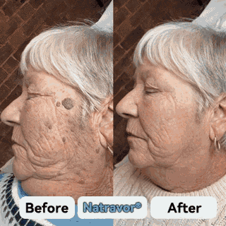 Natravor®💎 7-Day Skin Tag & Spot Eraser (Pain-Free, No-Scars Rollerball)