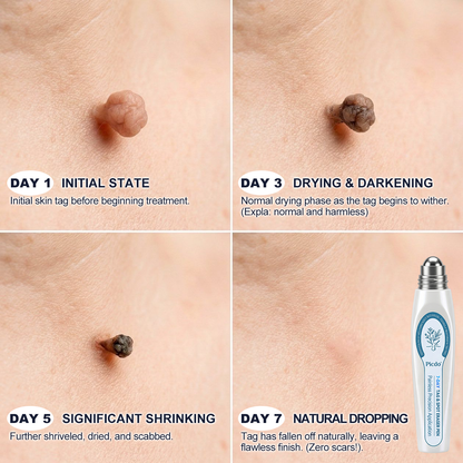 Natravor®💎 7-Day Skin Tag & Spot Eraser (Pain-Free, No-Scars Rollerball)